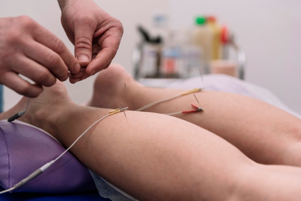 Electroacupuncture With The Needle Connection Machine. Electrical Stimulation In Physiotherapy In The Physiotherapy Center.